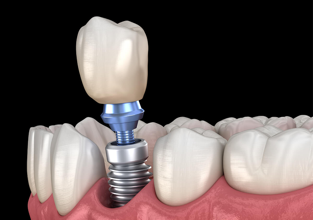 Implant Dentists in Ormond Beach FL Area